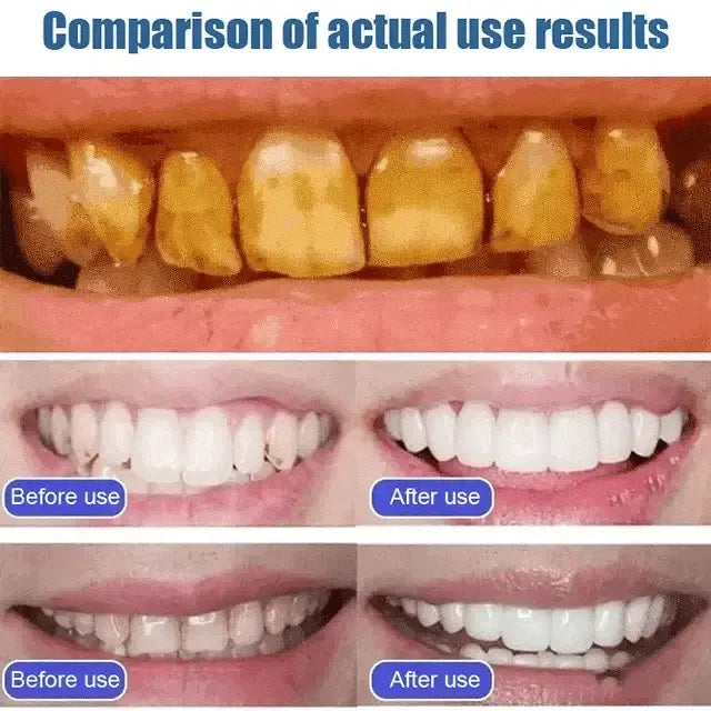 🦷 SP-6 Whitening Toothpaste | Probiotic Teeth Whitening for Stains, Bad Breath & Gum Health- ( Pack of 2)